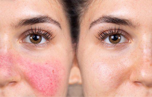 Skincare for Rosacea: Calm, Control, and Confidence